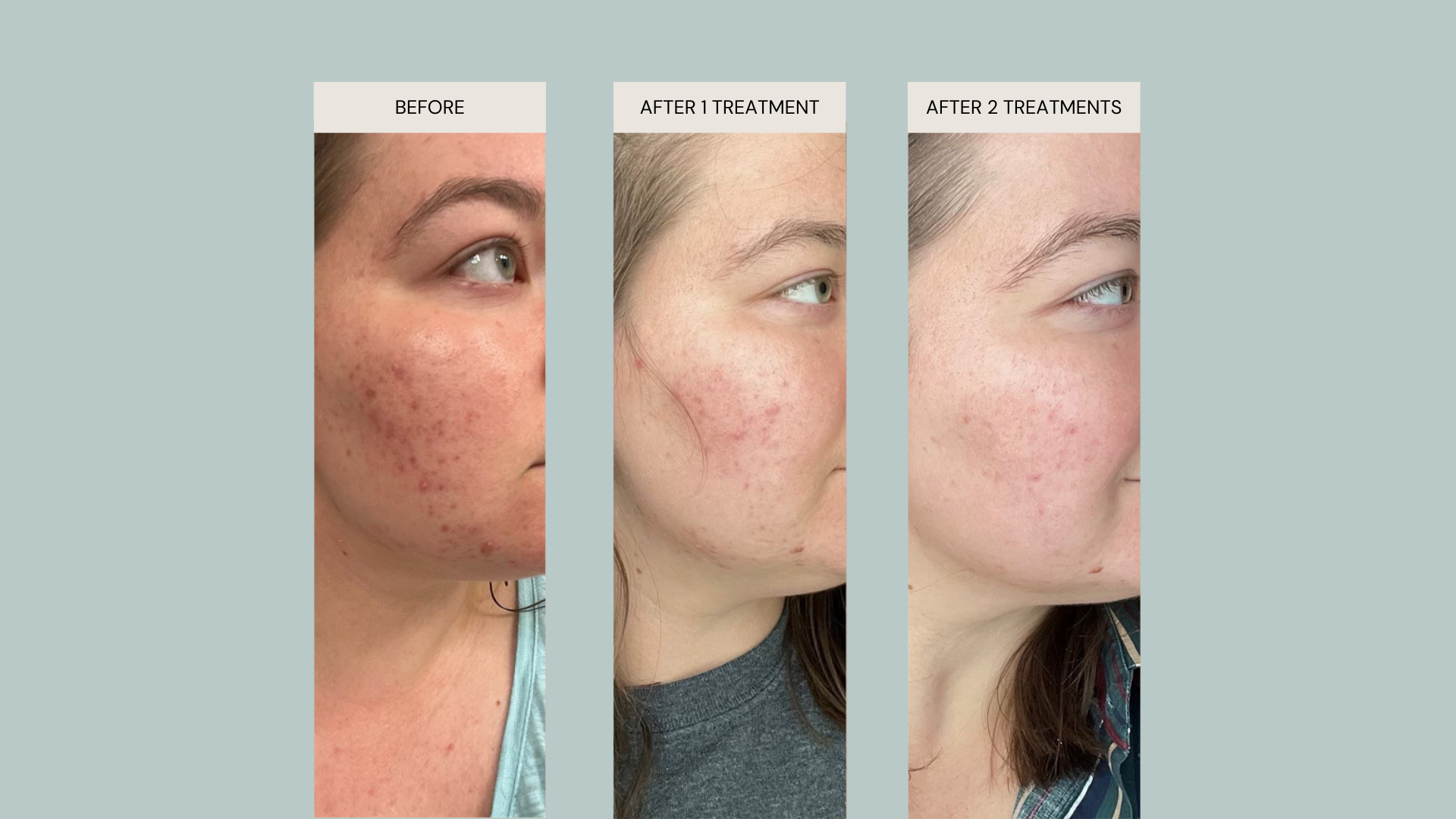 before and after photos of progressive treatments for the skinpen microneedling anjou spa